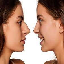 The Secret to a Beautiful Nose: Why Rhinoplasty in Dubai is the Place to Be